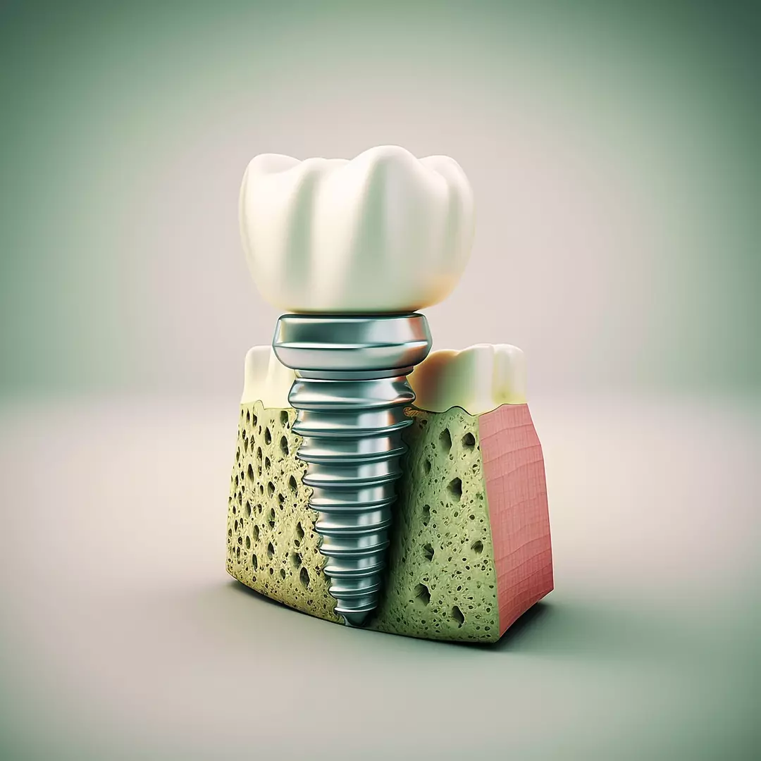 Implanty Zakopane,Implantolog,Implanty